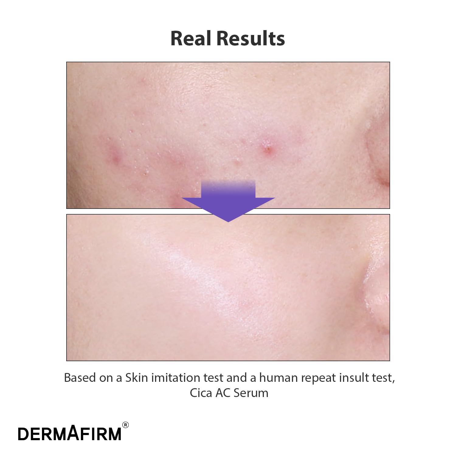 DERMAFIRM CICA AC Serum for Acne-Prone Skin – Korean Facial Serum with Exosome, Centella Asiatica, Niacinamide, Salicylic Acid & Vitamin B3 – Hydrating & Calming, 1.01 fl oz